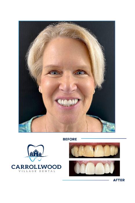 A carrollwood patient with veneers from Carrollwood Village Dental